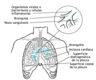 Bronquitis: El Significado Espiritual que Debes Conocer